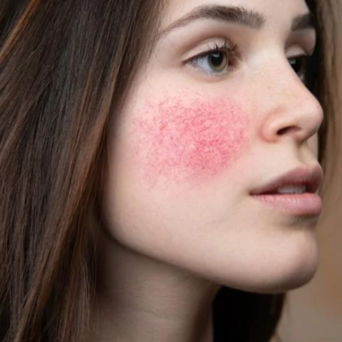 Co je růžovka a proč je zima problém