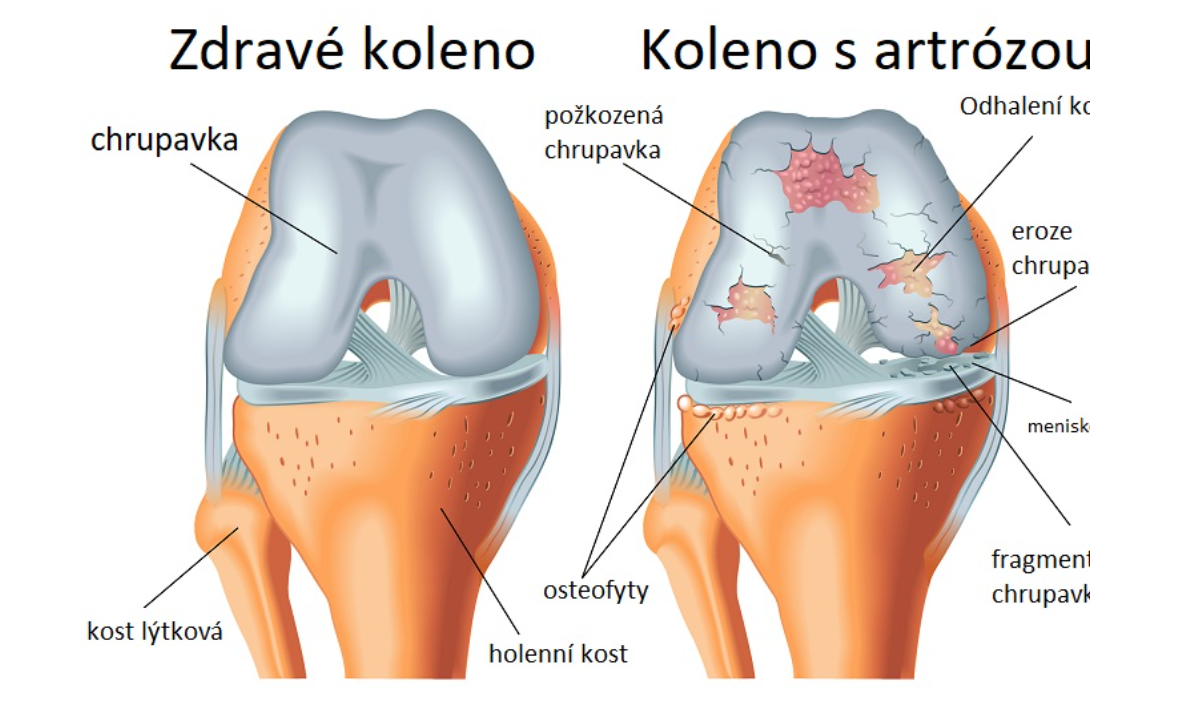 Osteoartróza: Jak pečovat o své klouby a pohybový aparát